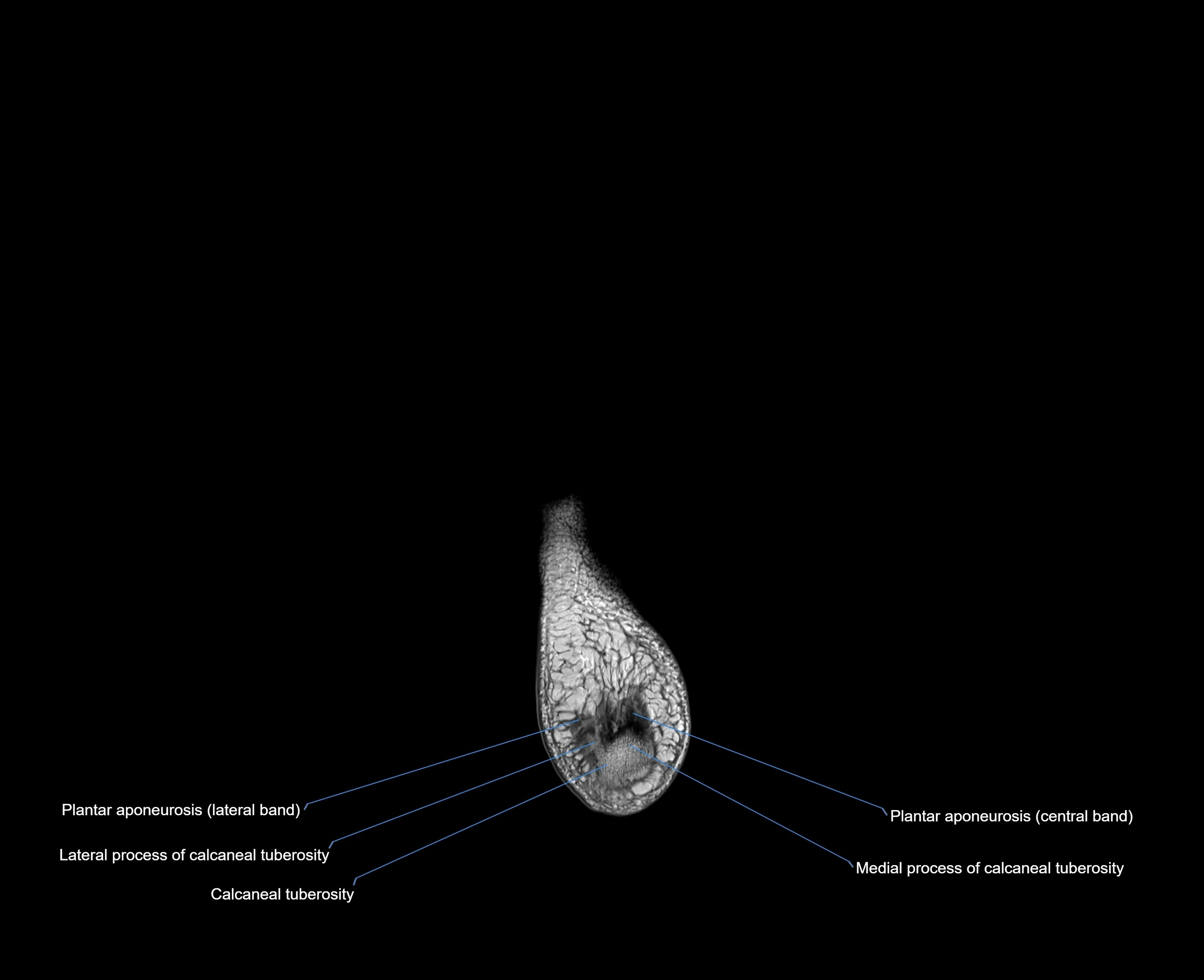 MRI foot coronal cross sectional anatomy 3T  radiology  image-img-00001-00033.webp